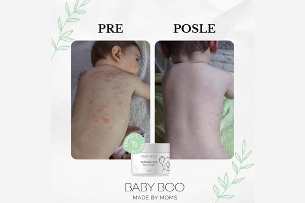 Prirodne kreme za ekcem